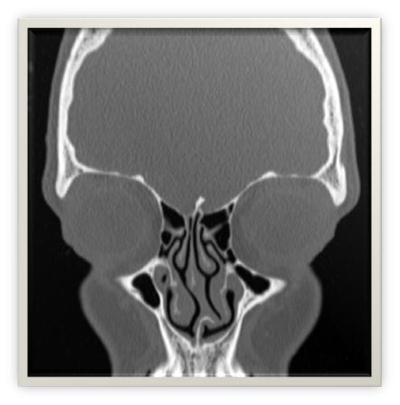 Nez-Sinus