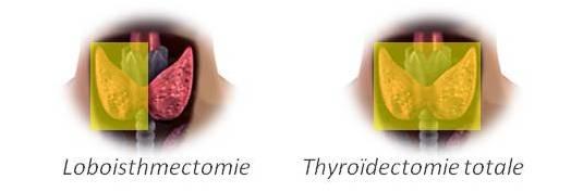 thyr-lobectomie-ou-totale-1.jpg